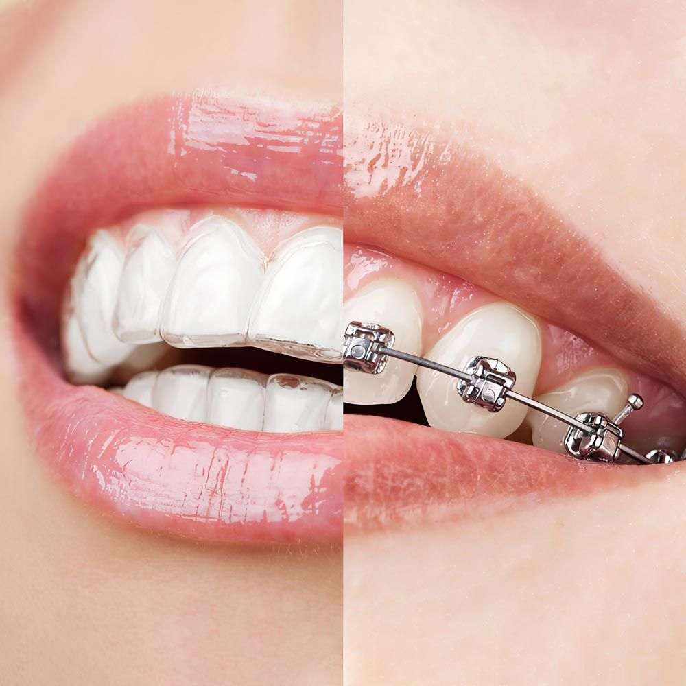 smile with Invisalign and braces