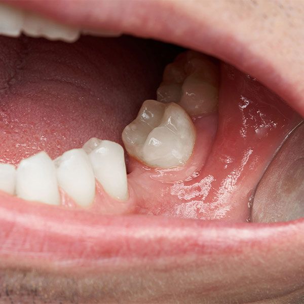 missing tooth