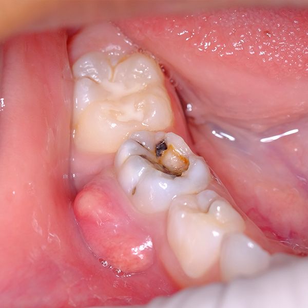 root canal