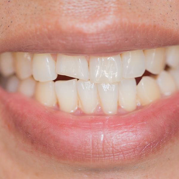 chipped tooth