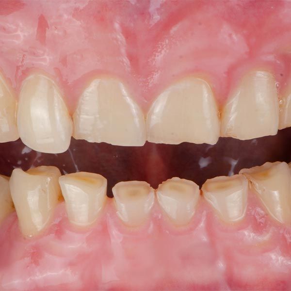 worn teeth